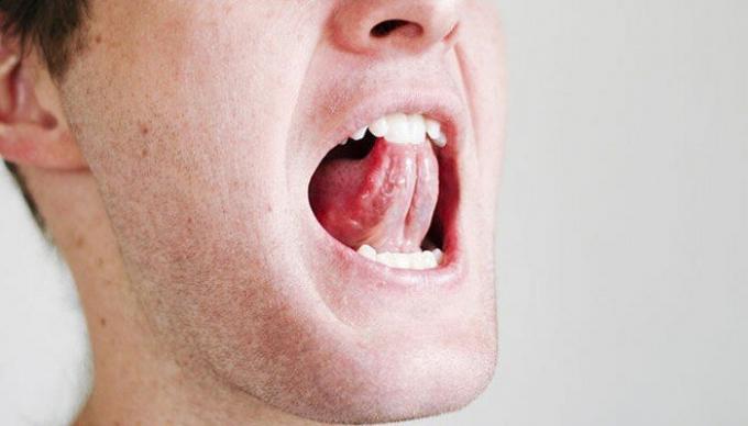 Sebuah latihan sederhana untuk tenggorokan dan lidah dapat meringankan situasi dengan mendengkur. / Foto: i2.wp.com. 